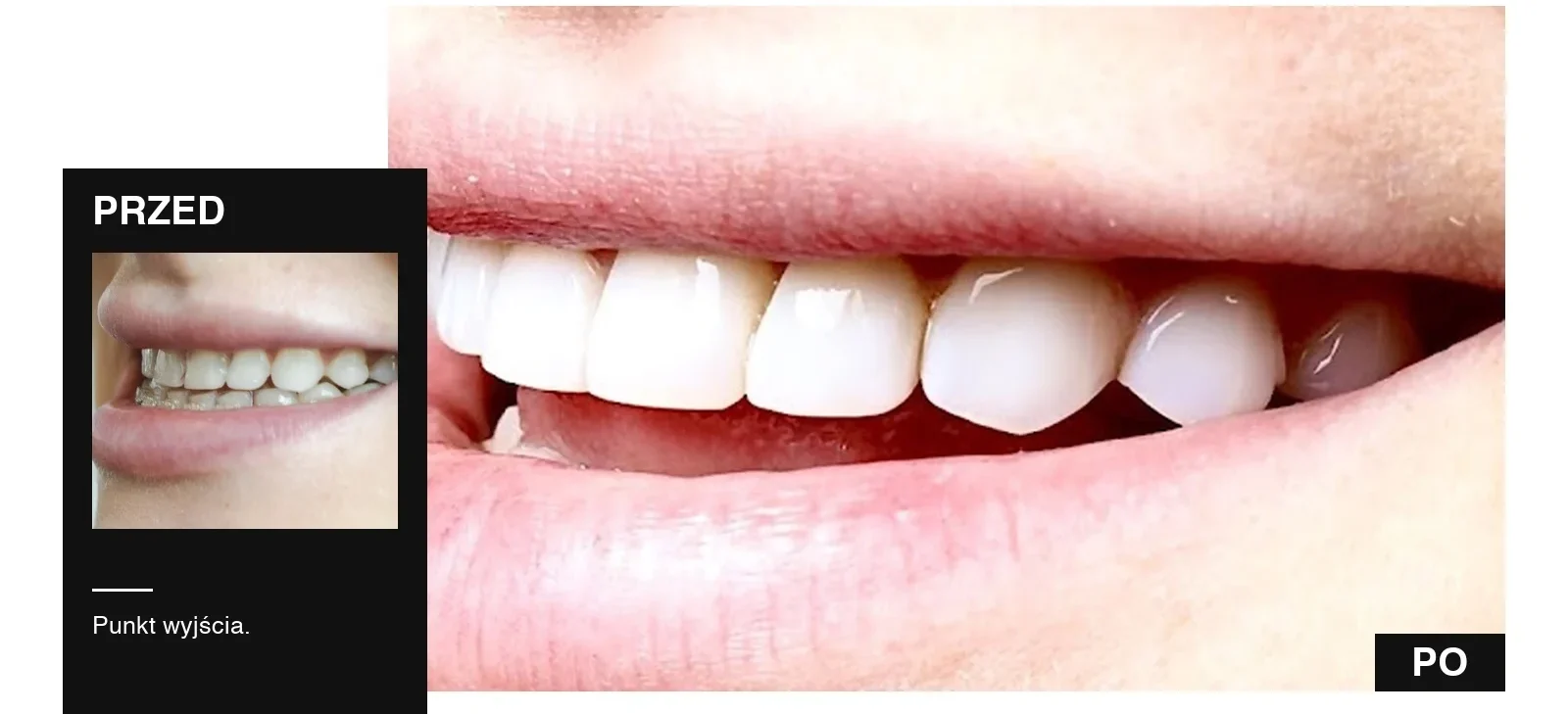 Bonding zębów przed i po, przypadek z gabinetu Ars Dentistica