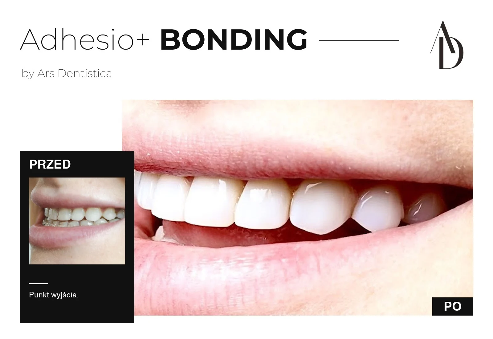 You are currently viewing Bonding zębów w Krakowie, protokół Ars Dentistica Adhesio+